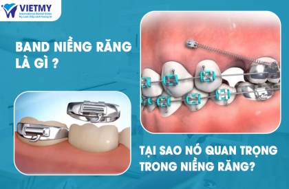 Band Niềng Răng Là Gì Và Tại Sao Nó Quan Trọng Trong Niềng Răng?